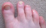 onychomycosis-1 onychomycosis-1