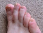onychomycosis-2 onychomycosis-2