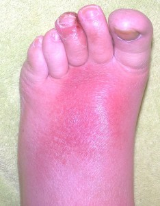 sunburn on foot