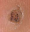 plantar wart plantar wart